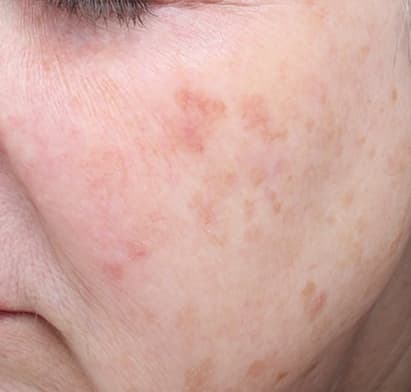 How to Treat Hyperpigmentation